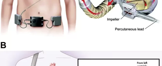 Diagram illustrating a continuous flow LVAD connected to a heart, featuring detailed blood flow paths and components akin to turbomachinery, such as the pump, rotor, and power supply. Developed with precision engineering principles from Softinway.