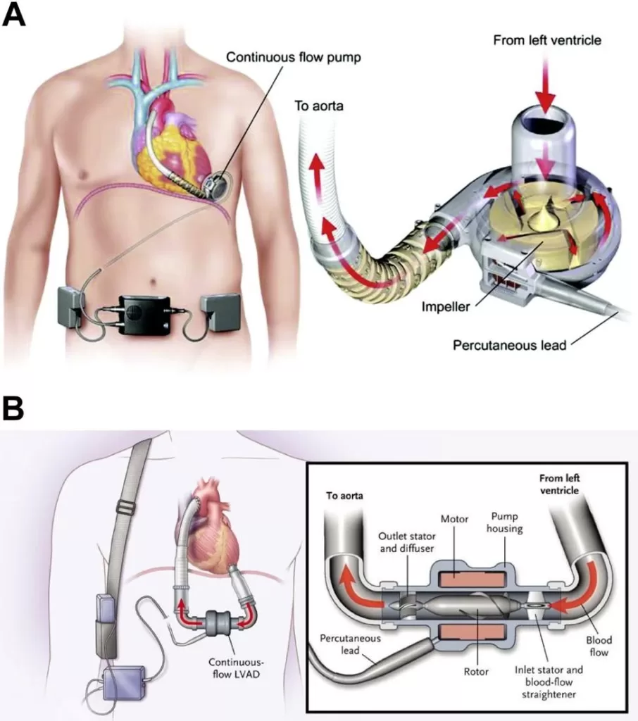 Fig. 1 - Left ventricular assist device - a tiny pump moving the blood in the human body